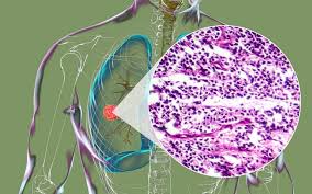 Image result for Lung Cancer
