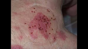 Maybe you would like to learn more about one of these? Comment Se Debarrasser Des Punaises De Lit Youtube