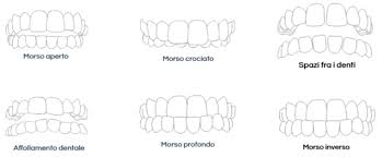 Le mascherine dentali sono state inizialmente pensate più per adulti che per ragazzi, poiché talvolta può succedere anche in età adulta di avere problemi di riallineamento dentale magari a causa di. Ortodoncia Dentista In Albania