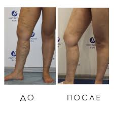 Vosstanovlenie Posle Miniflebektomii Institut Ven Lechenie Varikoza V Kieve I Harkove