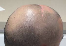 As we've covered before, male pattern baldness is caused by a combination of hormones and genetics — namely, a genetic sensitivity to dht. Sodium Lauryl Sulfate Induced Hair Loss In 2021 Jack S Hair Loss Reviews