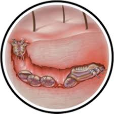 Image result for scabies on genitals