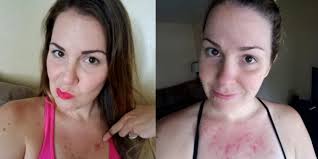 Basal Cell Carcinoma