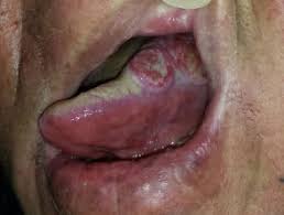 Jaw cancer results in pain in the area with difficulty in opening the mouth. Oral Cancer Dermnet Nz