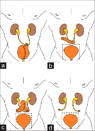 Diversion books, an american publisher. Types Of Urinary Diversion Surgery A Orthotopic Neobladder Download Scientific Diagram