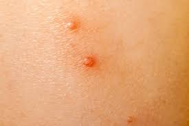 Learn about treatment, home remedies, and other symptoms associated with this viral infection. Molluscum Contagiosum Caring For Kids