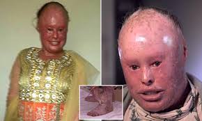 Read on to know about the causes, symptoms and treatment of this here are some pictures of harlequin ichthyosis syndrome that will give you an idea about the appearance of skin affected by this disease. Coverntry Woman Is Oldest With Rare Skin Condition Daily Mail Online