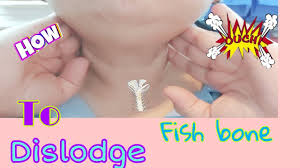 The weight could dislodge the bone. Healthytips How To Remove Fish Bone Stuck In Your Throat The Easy Way Youtube