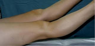 The knee is bent upwards beyond the straight position it's supposed to have. Is Full Hyperextension Needed After Knee Surgery Nasmi