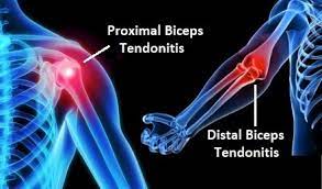 Biceps Tendonitis: Causes, Symptoms & Treatment