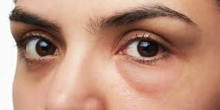 Ringe Unter Den Augen Augenringe Ursachen Und Hausmittel Heilpraxis