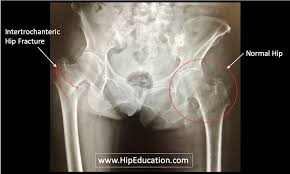 Image result for Hip XRay