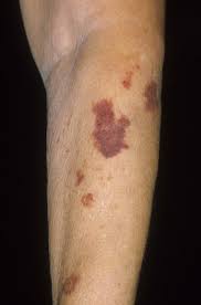 Causes of purple spots on skin. Melanoma Purple Skin Patch