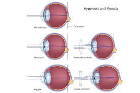 Image result for Myopia