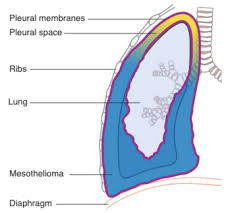 Symptoms of mesothelioma are often misdiagnosed as more common conditions. Mesothelioma Physiopedia