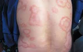 Since being founded in 1924 they have helped to diagnose, treat and rehabilitate people affected by leprosy. Suma Michoacan 15 Casos De Lepra En Lo Que Va De 2020 Noticias Locales Policiacas Sobre Mexico Y El Mundo El Sol De Zamora Michoacan