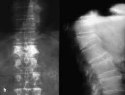 Image result for Vertebral Compression Fracture