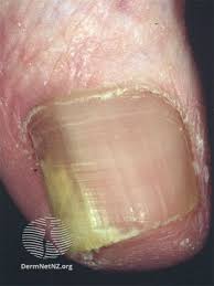 Image result for onychomycosis