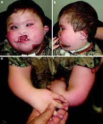 3p mosaic deletion duplication syndrome is one of the rarest genetic/chromosomal conditions that involve both deletion and duplication of chromosome 3, which is congenital. Holoprosencephaly Springerlink