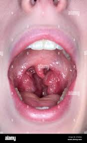 Image result for Strep throat infection roof of mouth