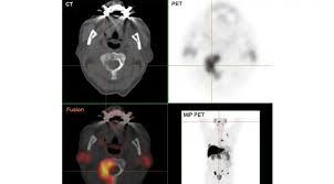 Learn the signs and symptoms of prostate cancer, along with causes and treatments. Early Stage Prostate Cancer Tests And Diagnosis