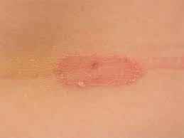 9 Best Home Remedies For Ringworm Infection Styles At Life Home Remedies For Ringworm Ringworm Remedies Ringworm