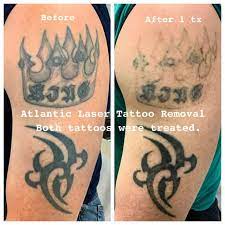 First and only legal tattoo shop in newport news. Atlantic Laser Tattoo Removal Tattoo Cover Ups And Tattoo Removal