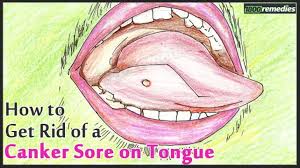 Tongue Canker Sore Causes And Treatments Canker Sore Tongue Sores Canker Sore On Tongue