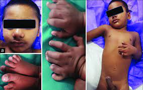 Check spelling or type a new query. A 2 Year Old Male Child With Delalande S Type 3 Hh Presented With Both Download Scientific Diagram