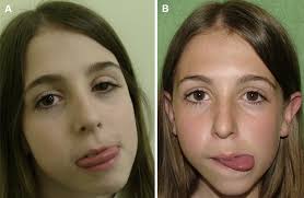 Sclerotherapy for vascular malformations: Complications and a review of  techniques to avoid them