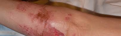 Los Angeles Motorcycle Accident Burns And Road Rash Injury Attorneys