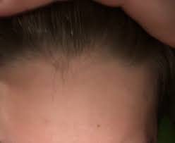 Hereditary hair loss with age is the most common cause of baldness. 15 Years Old And Balding Losing Hair As A Teenager Hairlosstalk Forums