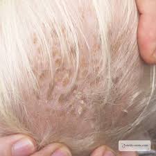 Image result for white scabs on the head in children