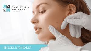 Professional Mole Assessment & Removal at Calgary Vein & Laser