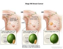 If breast cancer does come back, it&#x27;s known as. Cancerhelp Online Nci Cancer Diagnosis And Treatment
