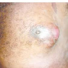 It's unclear whether the reported rise means the disease is slowly becoming more common, or whether men better understand the symptoms and report their symptoms, leading to diagnoses that might have been missed in the past. Pdf Male Breast Cancer In Fiji A Descriptive Study