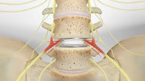 We would like to show you a description here but the site won't allow us. Spinal Disc Replacement Supporting Pain Free Mobility Through Next Generation Spinal Prosthesis Joint Surgeon Com