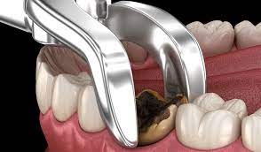 Tooth Extraction Cost For 2021 Procedure Risks Recovery