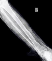 Broken Tibia At Ankle Recovery Time 10 13 Weeks Leg Fracture Xray Inlinespeedskating Injury Bones Broken Medical Dental X Ray Broken Bone
