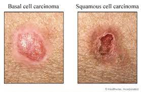 Basal and squamous cell skin cancer are types of skin cancer that are found on the outer layer of the skin. Basal And Squamous Cell Skin Cancers My Doctor Online