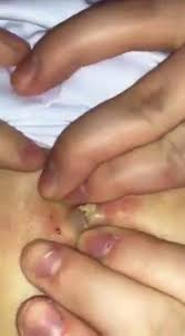 Cosmo breaks down the ingredients list to find out more. Gee Blackhead Removing This Big Blackhead Is So Satisfying And Disgusting At The Same Time Facebook