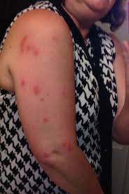 Ποια εστιατόρια είναι κοντά στο days inn by wyndham orlando/international drive; Bed Bugs Picture Of Quality Inn Orlando Tripadvisor