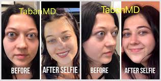 Thyroid Eye Disease Beverly Hills Graves Eye Surgery Taban