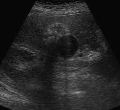 Adenomyomatosis is one of the hyperplastic cholecystoses. Https Nanopdf Com Download Les Lesions Parietales De La Vesicule Pdf