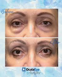 Ocala Eye Aesthetics