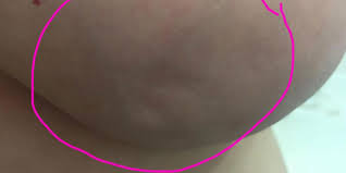 Correspondingly, does breast dimpling always mean cancer? Woman Posts Photos Of Her Breast Dimples For A Surprising Reason
