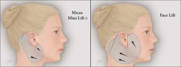 The celebrity face must be visible. Experience The Cutting Edge Micro Mini Facelift Procedure By Dr Godin
