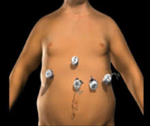 We offer unique financing services for surgeries at pompeii. Nyc Gastric Sleeve Gastric Sleeve Gastrectomy Nj Minimally Invasive