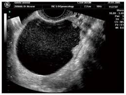 Prevalence in incidental simple adnexal cysts initially identified in ct examinations of the abdomen and pelvis. Ovarian Simple Cysts In Asymptomatic Postmenopausal Women Detected At Transvaginal Ultrasound A Review Of Literature