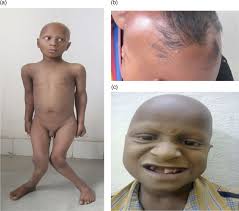 Image result for Rickets